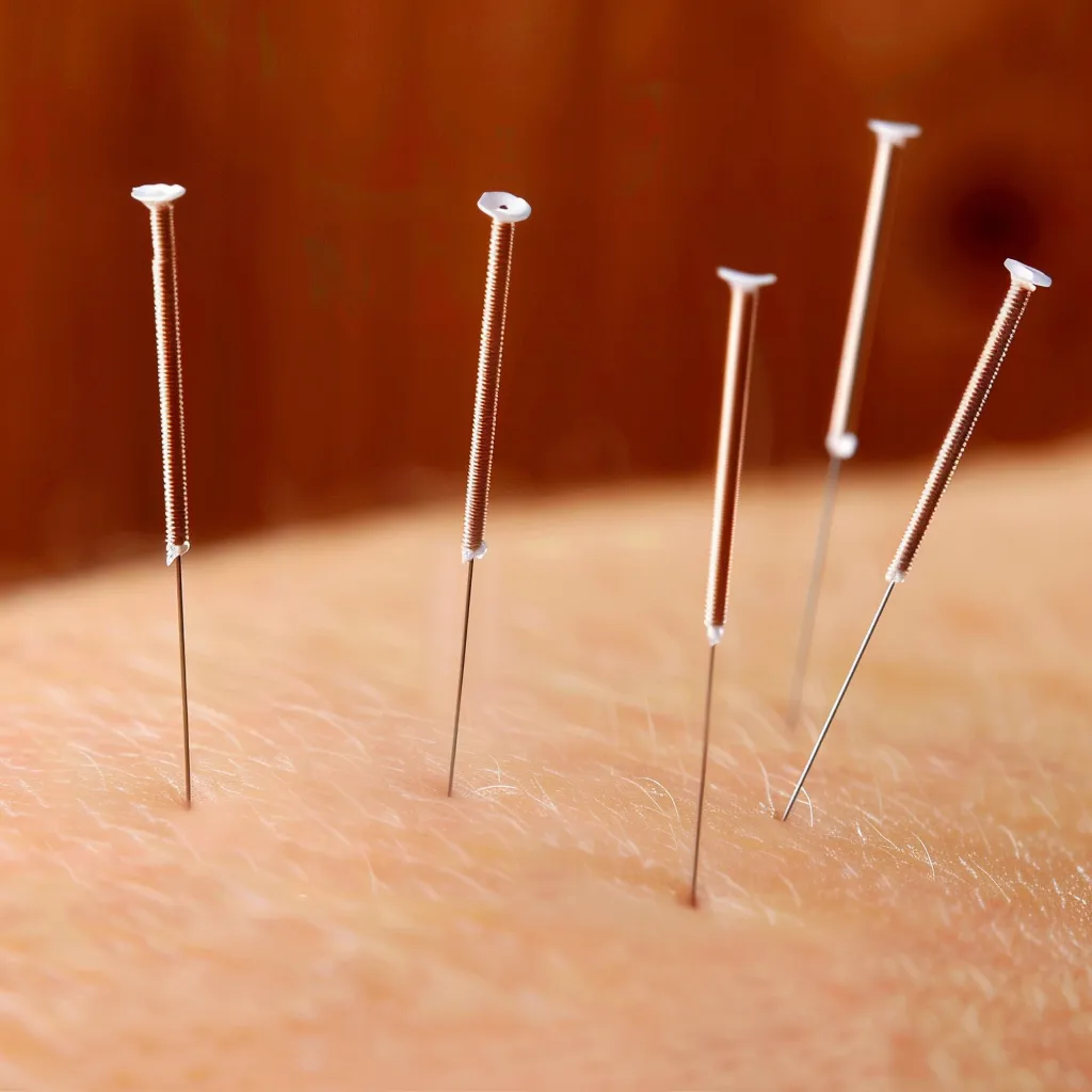 самое лучшее лечение иглоукалыванием